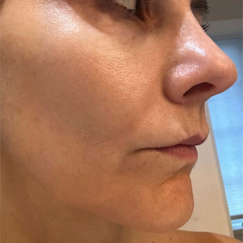 Does Oil Gritting Actually Help With Clogged Pores? I Tried It Closeup of author's pores on face