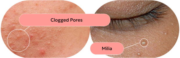 An Esthetician's Guide to Achieving Glass Skin skin with clogged pores and skin with milia