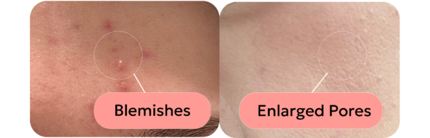 An Esthetician's Guide to Achieving Glass Skin skin with blemishes and skin with enlarged pores