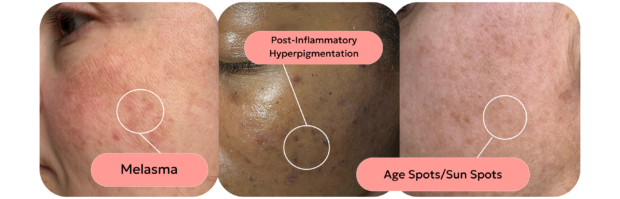 An Esthetician's Guide to Achieving Glass Skin skin with different types of pigmentation