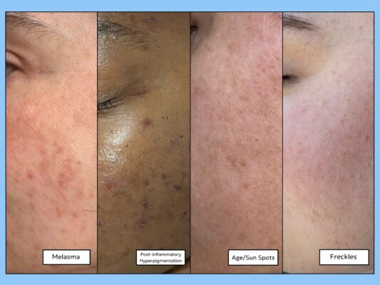 Types of Skin Discoloration & How to Get Rid of Them Fast four types of skin discoloration