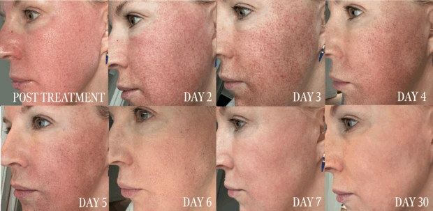 An Esthetician's Halo Laser Review And Recovery