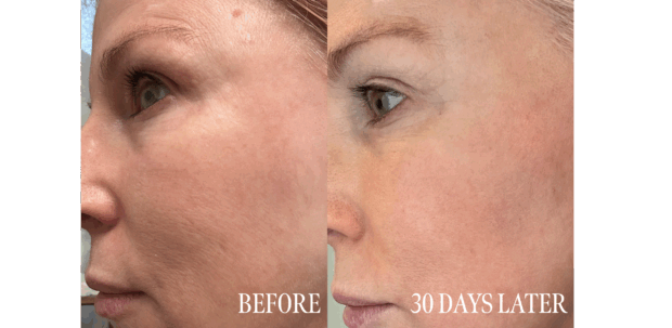 An Esthetician's Halo Laser Review And Recovery before and after laser treatment