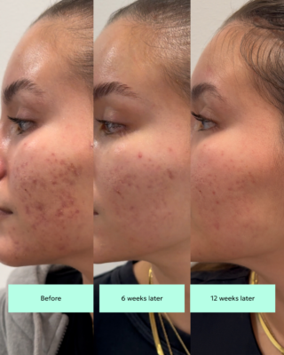 Tranexamic Acid - Esthetician Approved Ingredient before and after for fading hyperpigmentation with TXA